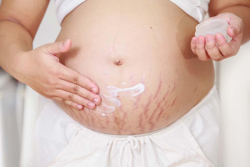 Belly Mask for Stretch Mark Treatment