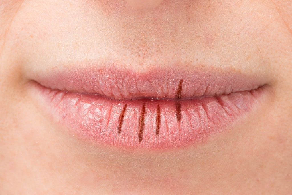 chapped lips treatment