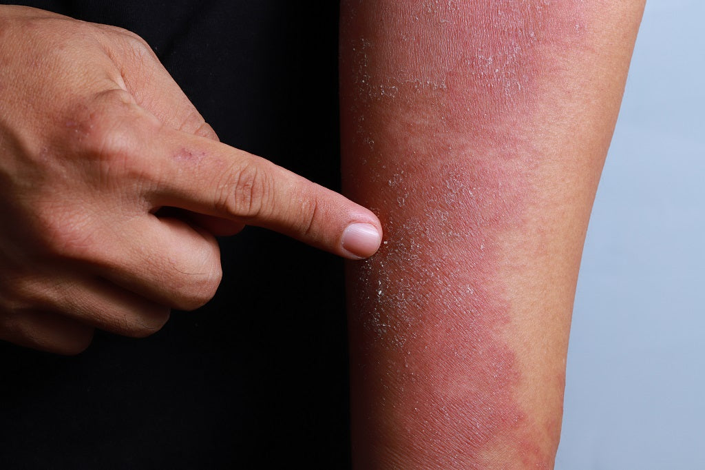 FInd out the risk factors and how to prevent skin's fungal