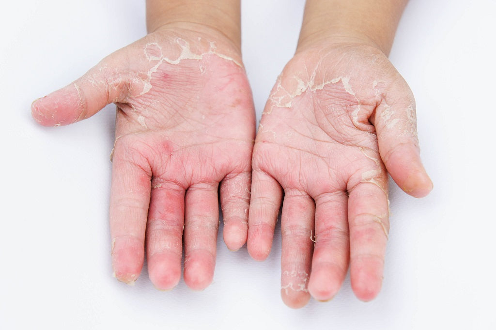 Dermatophyte Infection: What Is It, Causes, Signs and Symptoms, Diagnosis,  Treatment, and More